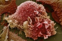 Khoa học phát hiện phương pháp điều trị ung thư mới
