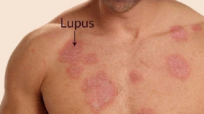 Lupus ban đỏ1